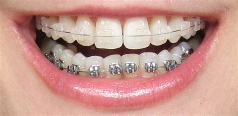 metal vs ceramic brackets|ceramic braces top metal bottom.